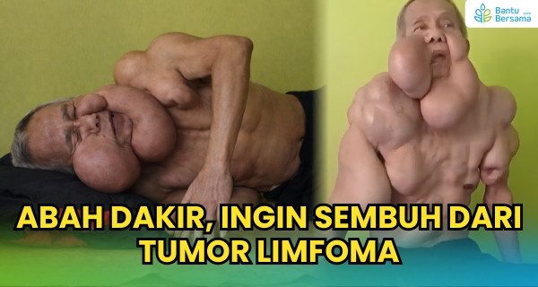 Abah Dakir, 31 Tahun Bertahan Hidup Dengan Tumor Yang Menggerogoti Tubuhnya