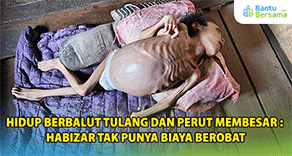 Hidup Berbalut Tulang Dan Perut Membesar : Habizar Tak Punya Biaya Berobat